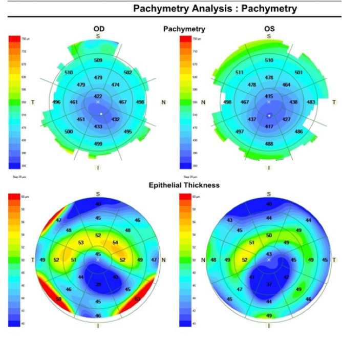 Keratoconus detected by OCT with epithelial thickness mapping at Las Vegas Eye Institute.