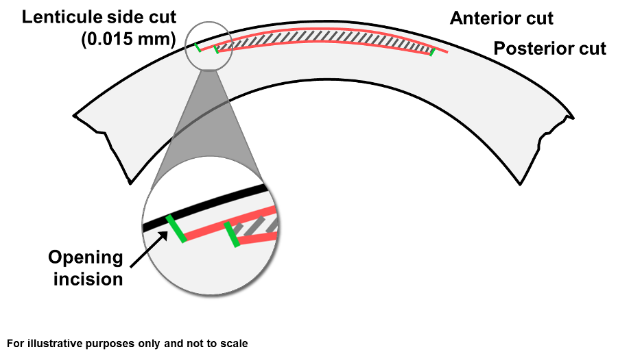 Schematic of SMILE eye surgery. An astigmatic lens is carved and removed to correct astigmatism.