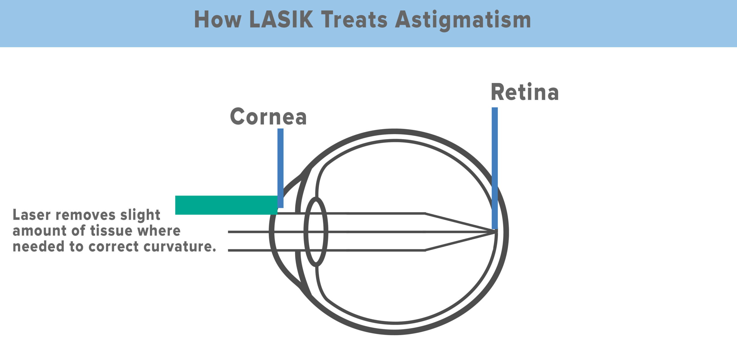 Diagram showing how LASIK treats astigmatism