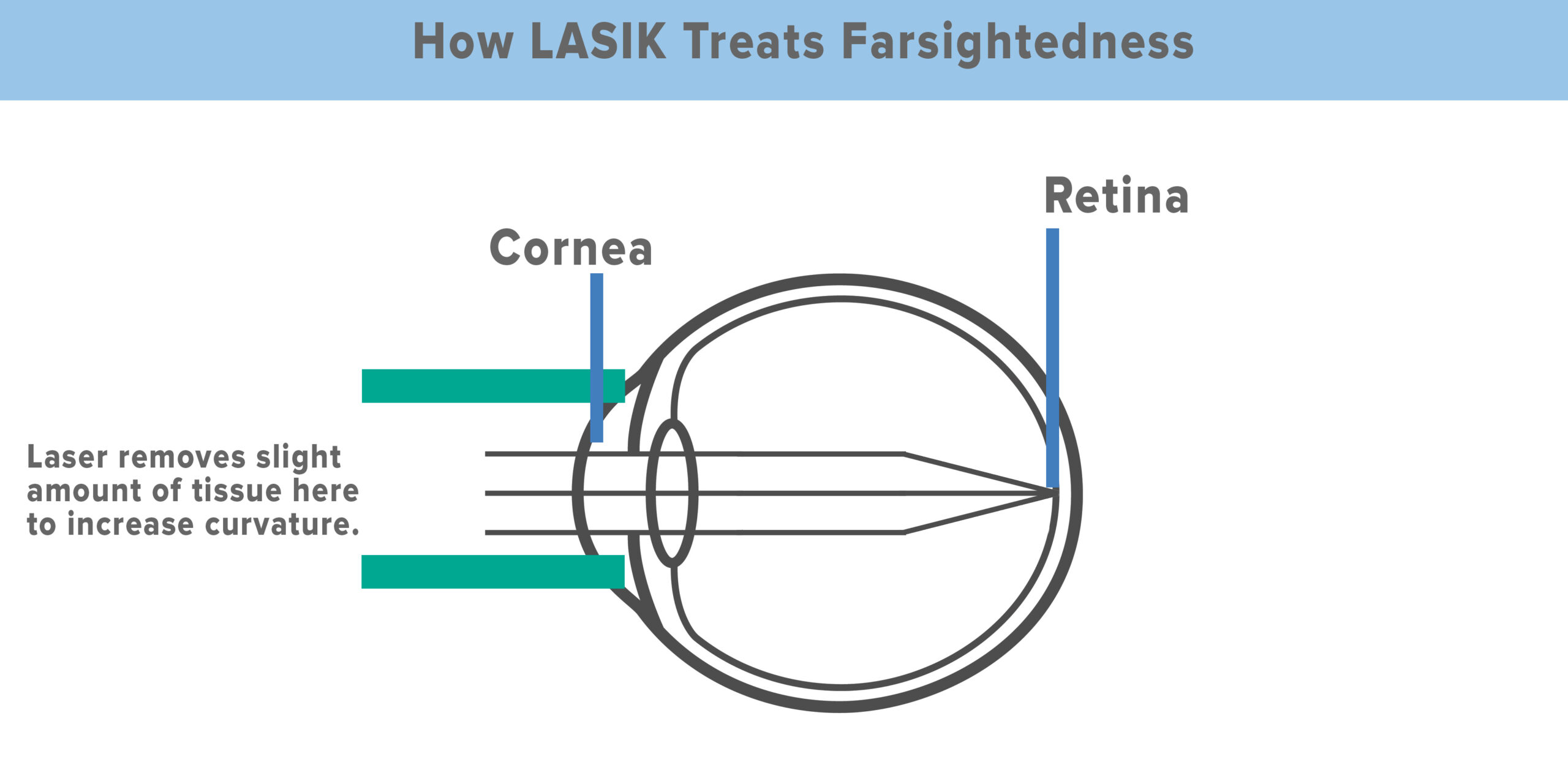 How LASIK corrects farsightedness