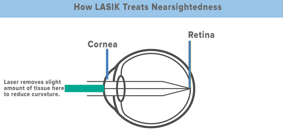 how lasik corrects nearsightedness