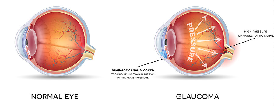 diagram of eye with glaucoma versus healthy eye