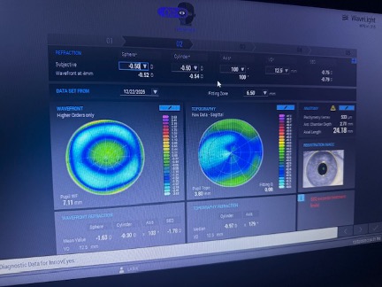 Planning a Wavelight Plus treatment with Wavefront, Topographic, Refractive, and Axial length data